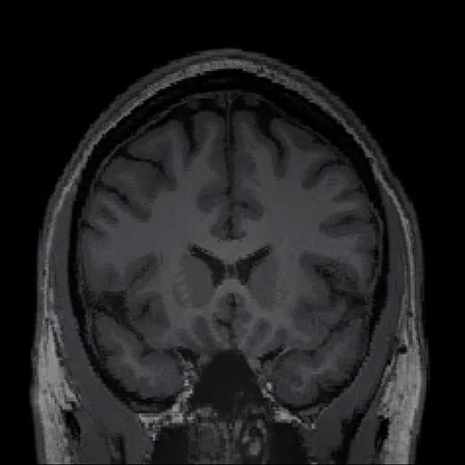 MRI-NEGATIVE
